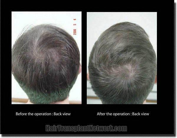 Hair restoration procedure results