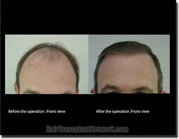 Hair restoration procedure results