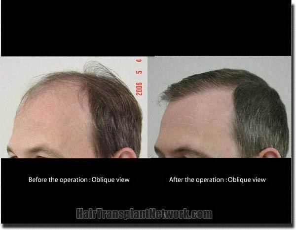 Hair restoration procedure results