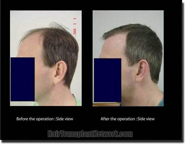 Hair restoration procedure results