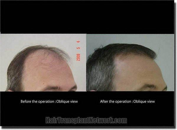 Hair restoration procedure results