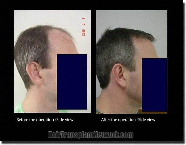 Hair restoration procedure results