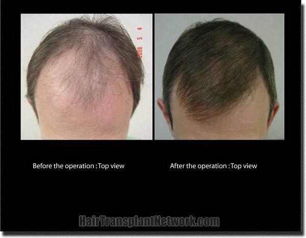 Hair restoration procedure results