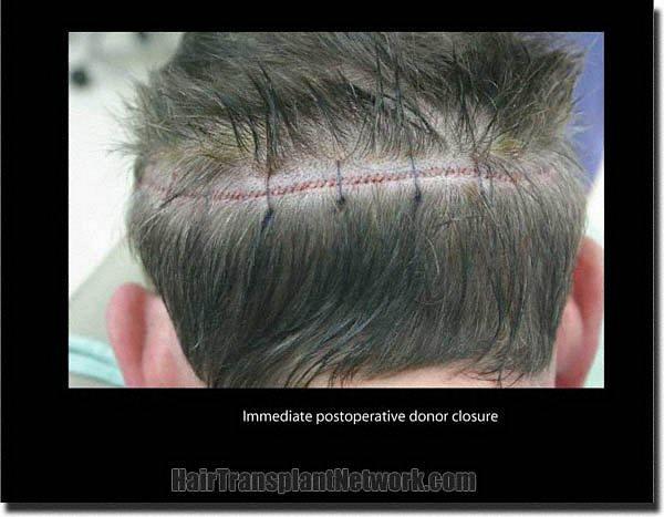 Hair restoration procedure results