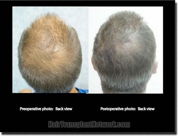 Hair restoration procedure results