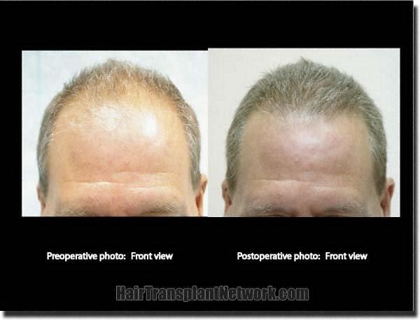 Hair restoration procedure results