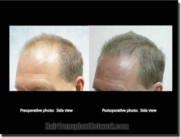 Hair restoration procedure results