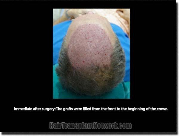 Hair restoration procedure results