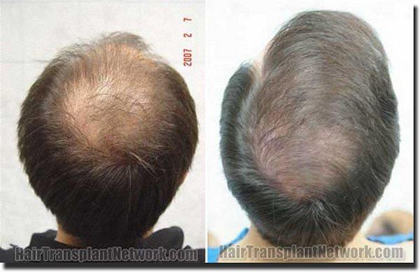 Hair restoration procedure results