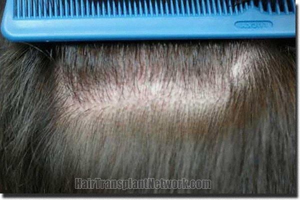 Hair restoration procedure results