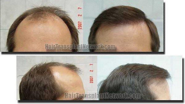 Hair restoration procedure results