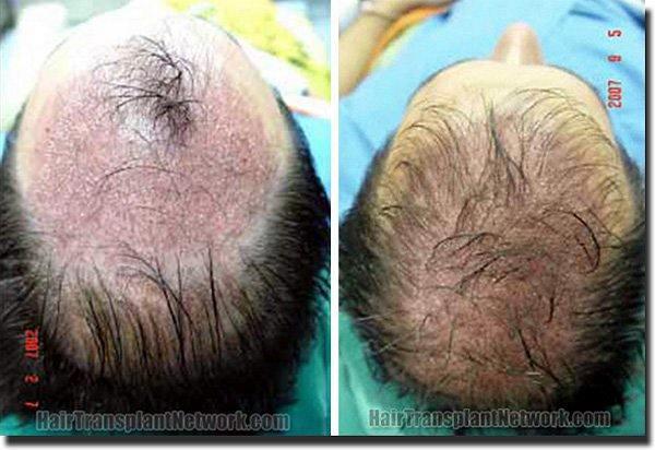 Hair restoration procedure results