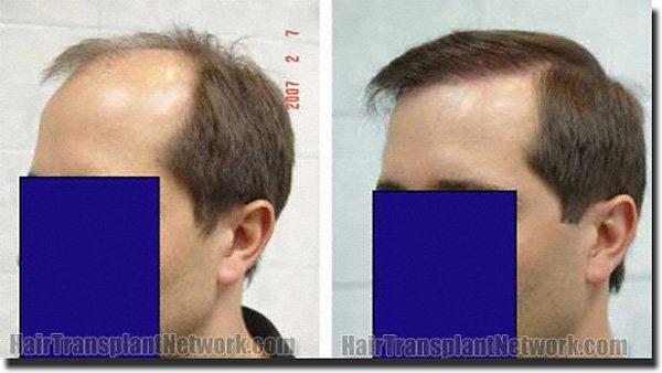 Hair restoration procedure results