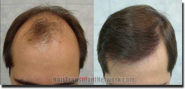 Hair restoration procedure results