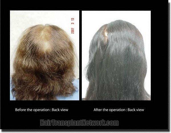 Hair restoration procedure results