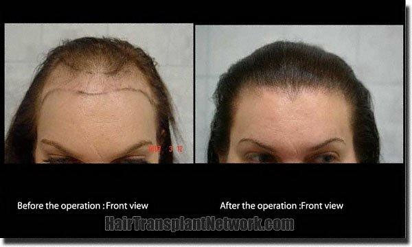 Hair restoration procedure results