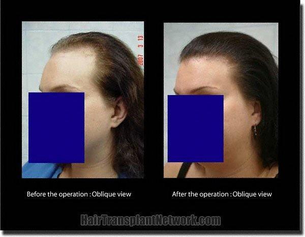 Hair restoration procedure results