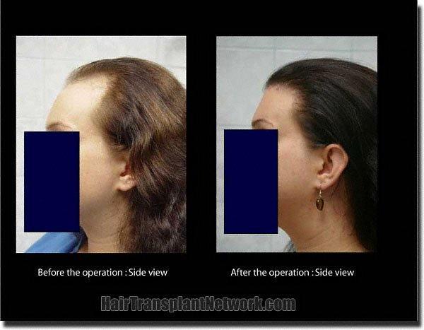 Hair restoration procedure results