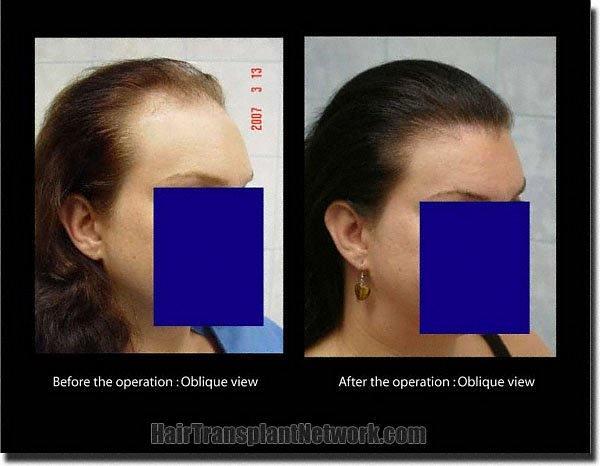 Hair restoration procedure results