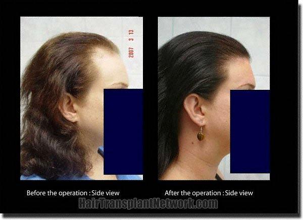 Hair restoration procedure results