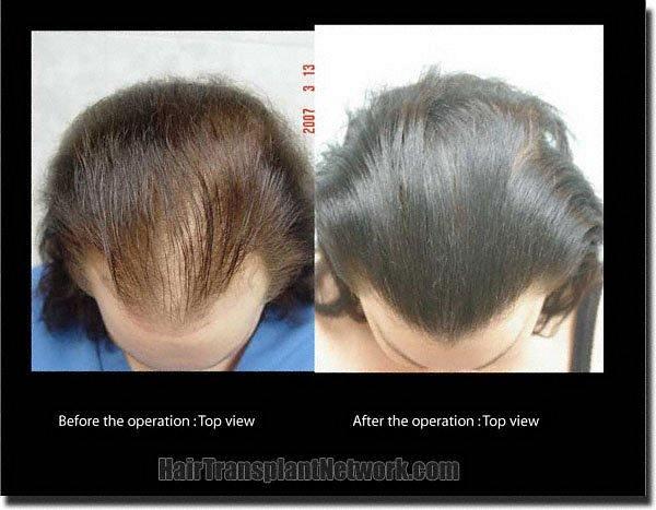 Hair restoration procedure results