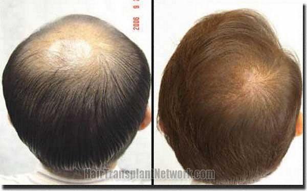 Hair restoration procedure results