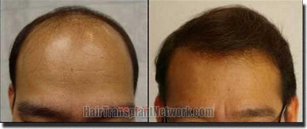 Hair restoration procedure results