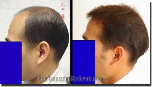 Hair restoration procedure results