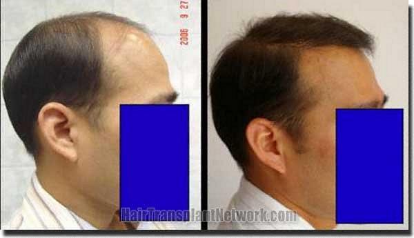 Hair restoration procedure results