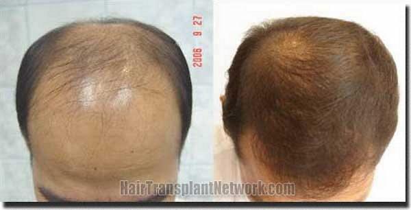 Hair restoration procedure results