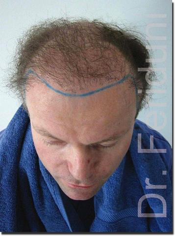 Hair restoration procedure results