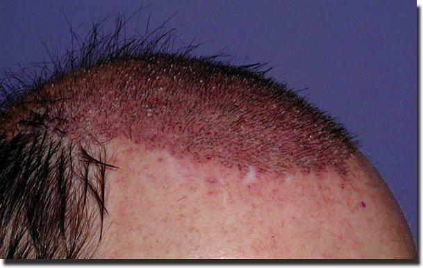 Hair restoration procedure results