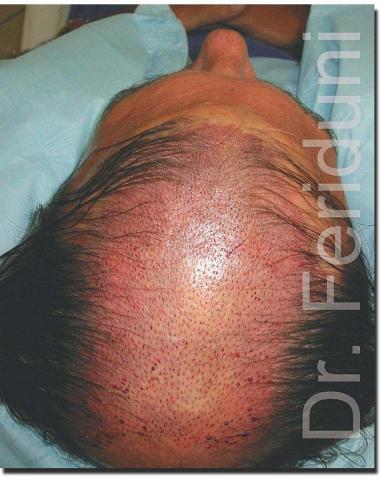 Hair restoration procedure results