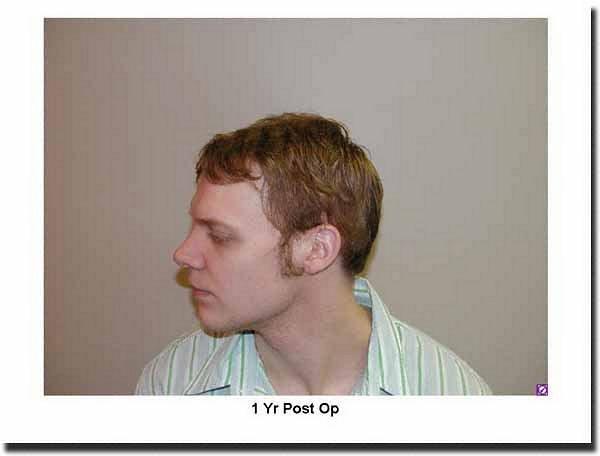 Hair restoration procedure results