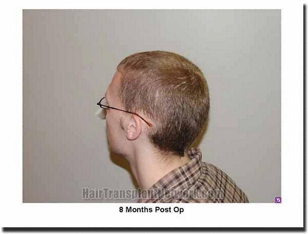 Hair restoration procedure results