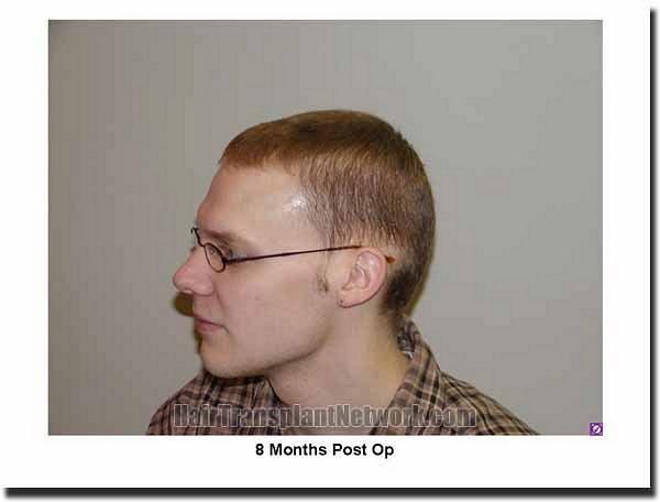 Hair restoration procedure results