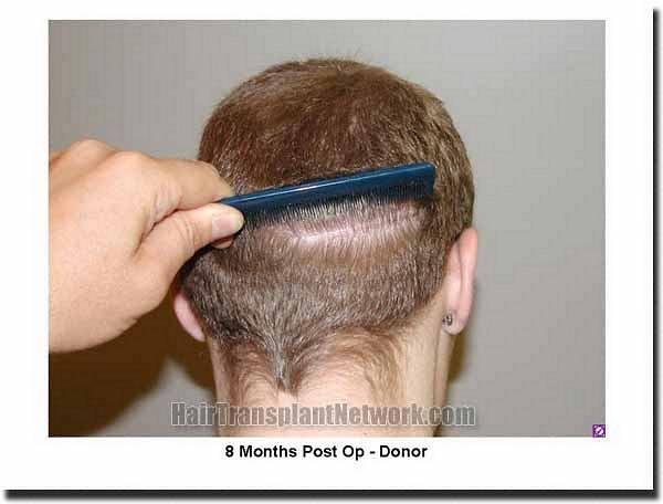 Hair restoration procedure results