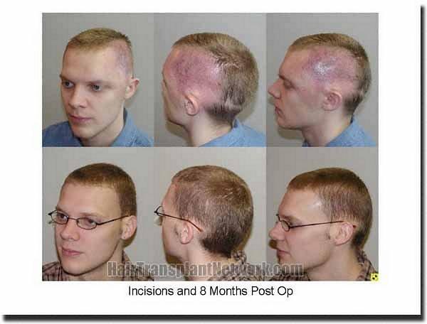 Hair restoration procedure results