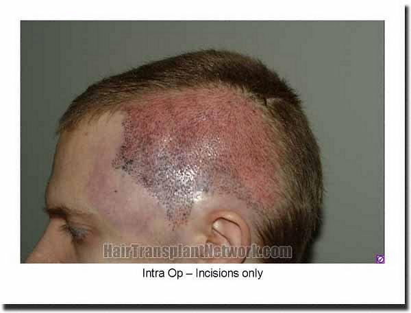 Hair restoration procedure results