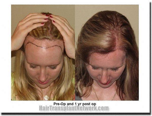 Hairline Lowering Procedures for Women with a High Forehead