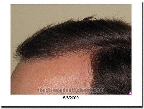 Hair restoration procedure results