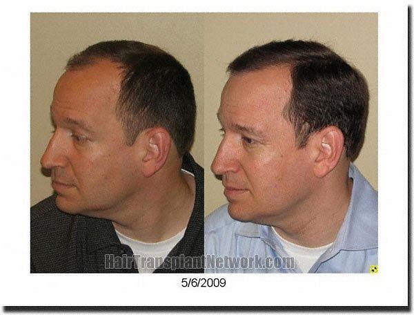 Hair restoration procedure results