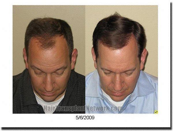 Hair restoration procedure results