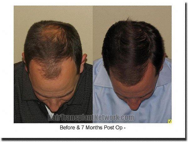 Hair restoration procedure results