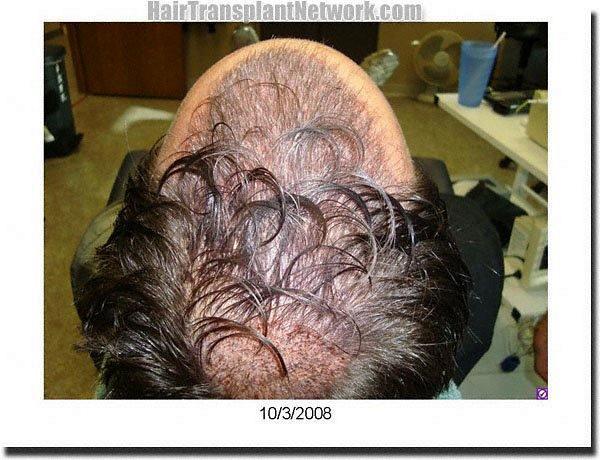 Hair restoration procedure results