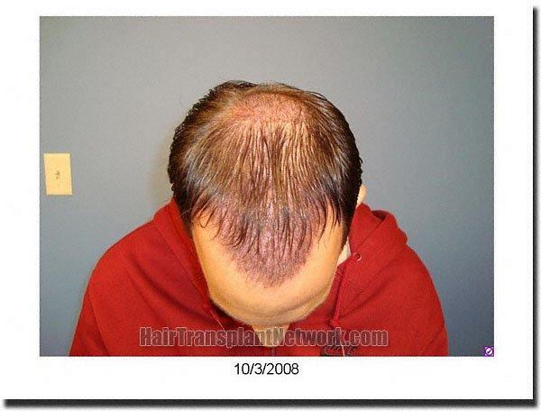 Hair restoration procedure results