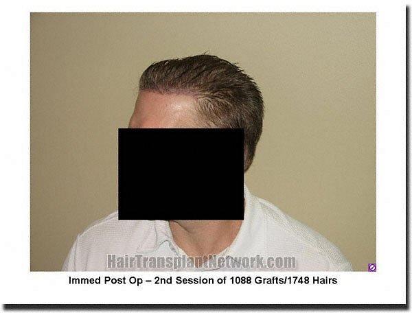 Hair restoration procedure results