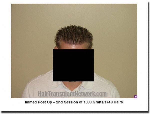 Hair restoration procedure results