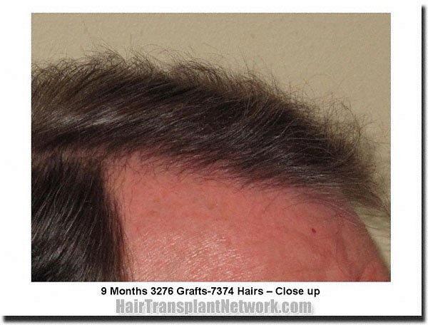 Hair restoration procedure results