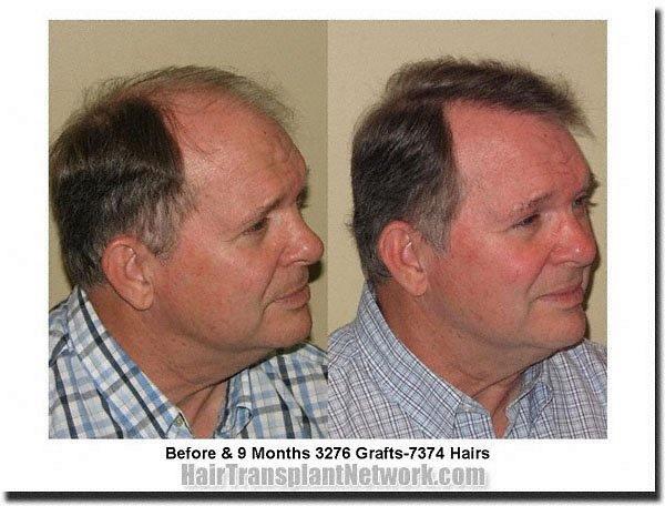 Hair restoration procedure results